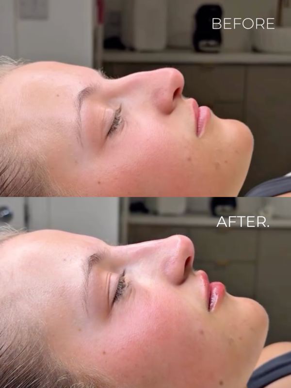 Image-Nose-Filler-Small-Curve-BA-Style-2.png