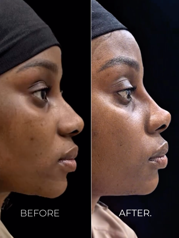 Image-Nose-Filler-Tip-Lift-BA.png