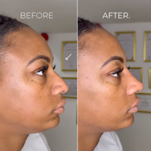 Image-Nose-Filler-TipBridge-BA.png