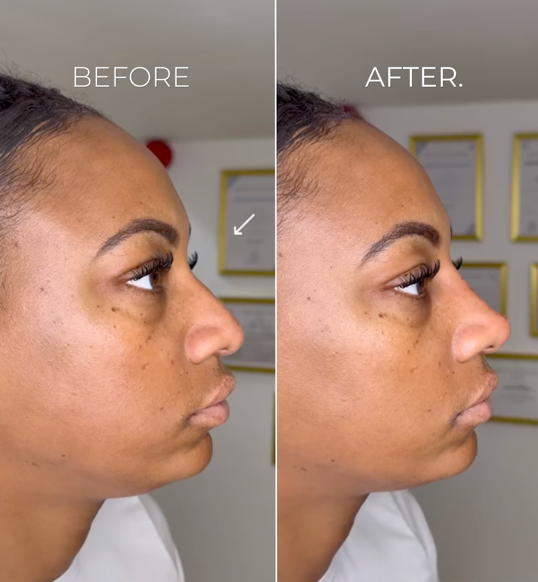 Image-Nose-Filler-TipBridge-BA.png