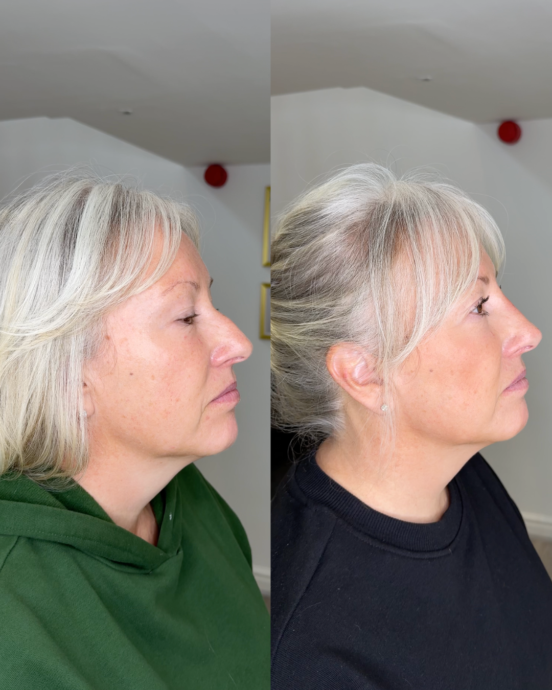 Image - Older Lady - B&A
