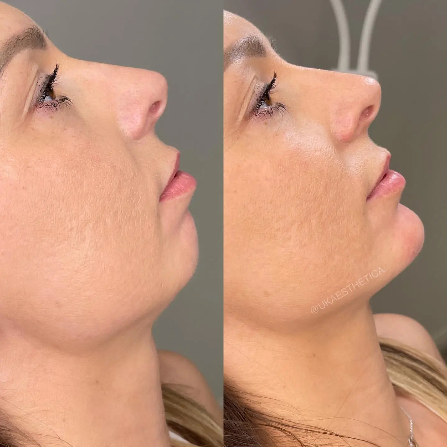 B&A - Chin Filer x2