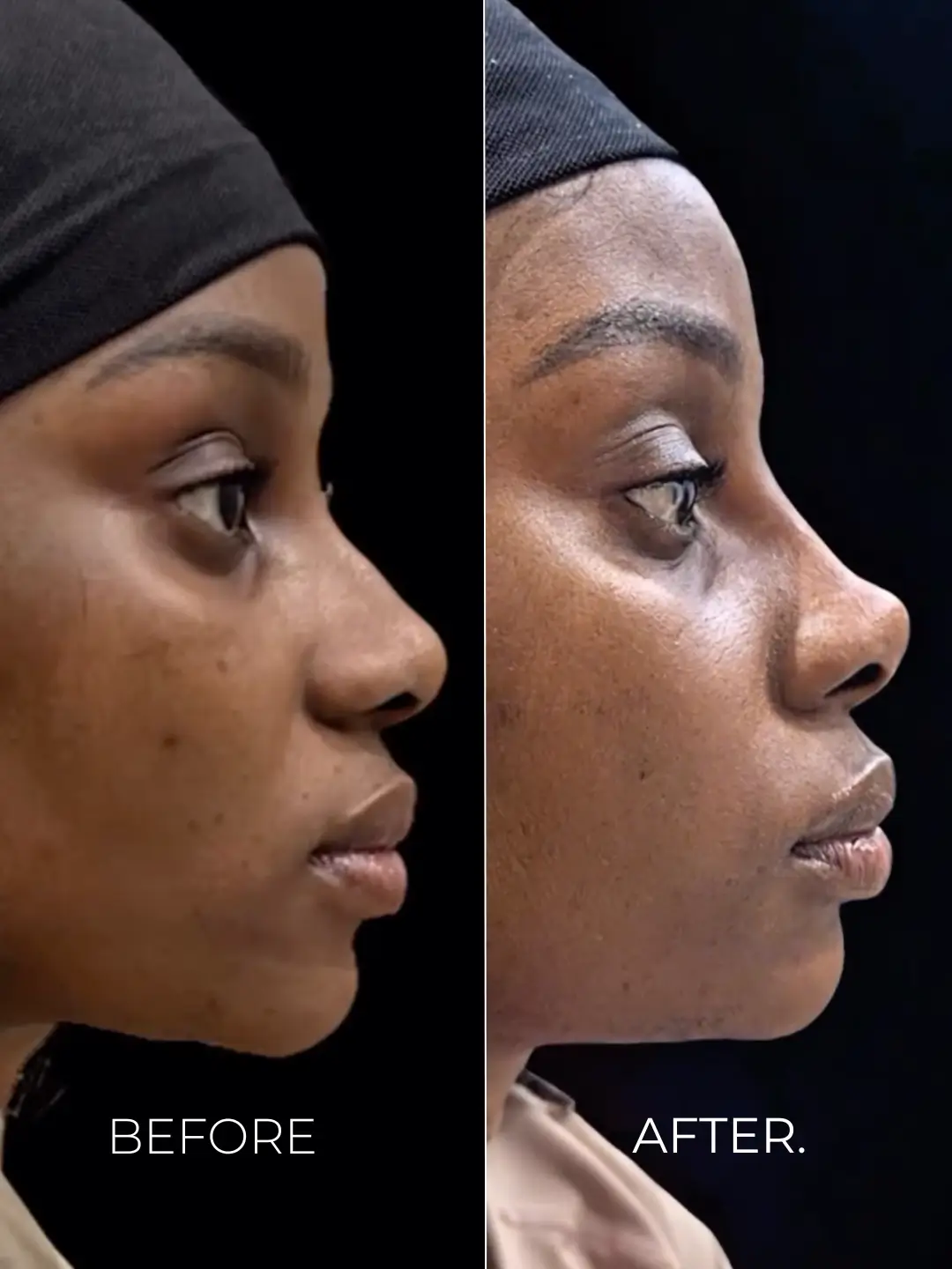 Image - Nose Filler - Tip Lift - B&A