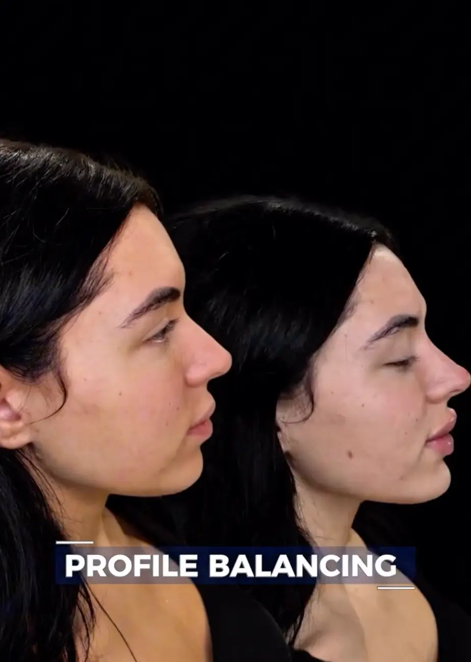 Image - Profile Balancing - Side Angle