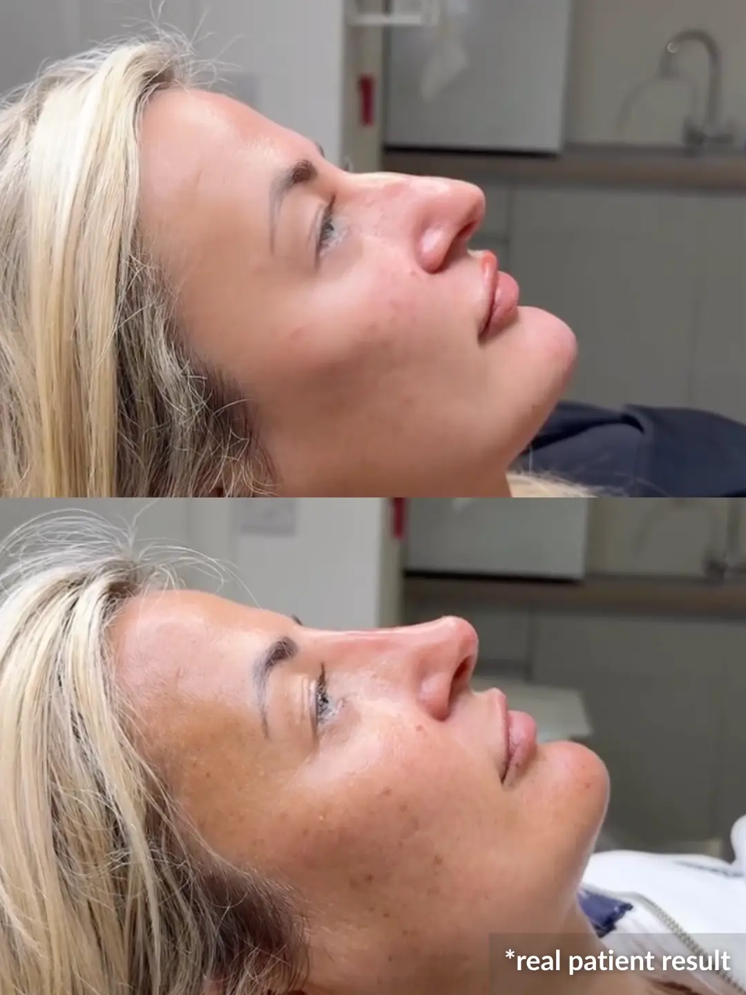 nose_filler_leeds_real_result (1)