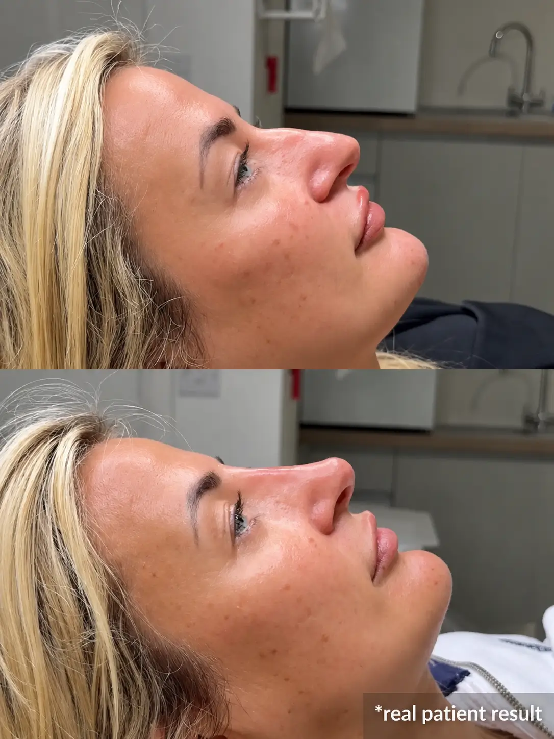hero_section_image_nose_Filler